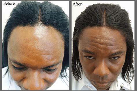 The success of the dr.upunch curl in treating this patient, as well as many others, has earned the dr.upunch curl the reputation as the best tool for fue hair transplant for black men available today. 15 Best Images Black Hair Transplant Before And After ...