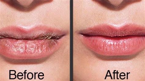 How To Heal Dry And Cracked Lips Home Remedies For Dry Lips In Winter