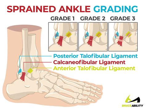 A Sprain A Twist Or A Roll Decipher Your Ankle Injury