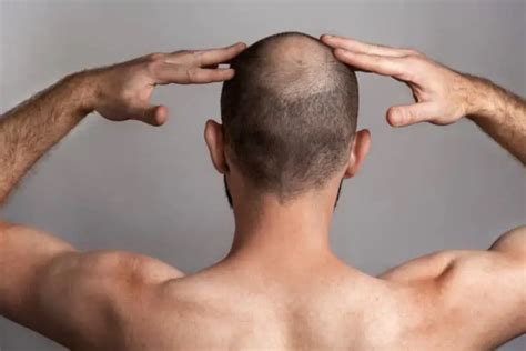 Early Signs Of Balding Causes Next Steps Bald Beards
