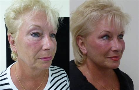Before And After Modified Facelift Upper And Lower Eyelid Lifts And