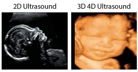 What In The World Is 3d4d First Look Sonogram