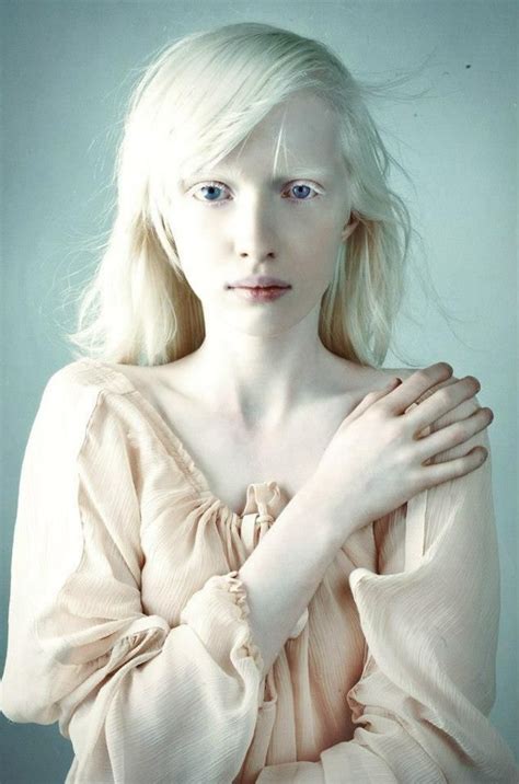 Nastya Kumarova For VOGUE Albinism Albino Model Portrait