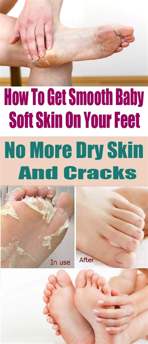 How To Get Smooth Baby Soft Skin On Your Feet No More Dry Skin And