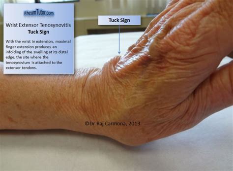Wrist Extensor Tenosynovitis · Rheumtutor