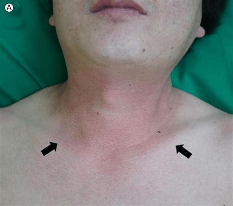A V Sign On The Neck And Anterior Chest Arrows B Diffuse