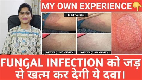 Fungal Infection।joke Itch।homeopathic Medicine For Cure। Youtube