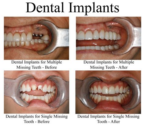 Replace Missing Teeth With Dental Implants
