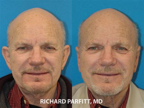 Ear Surgery Otoplasty Photos Dr Richard Parfitt