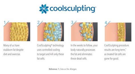 Coolsculpting® Procedure Dr Surfield