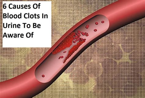 6 Causes Of Blood Clots In Urine To Be Aware Of