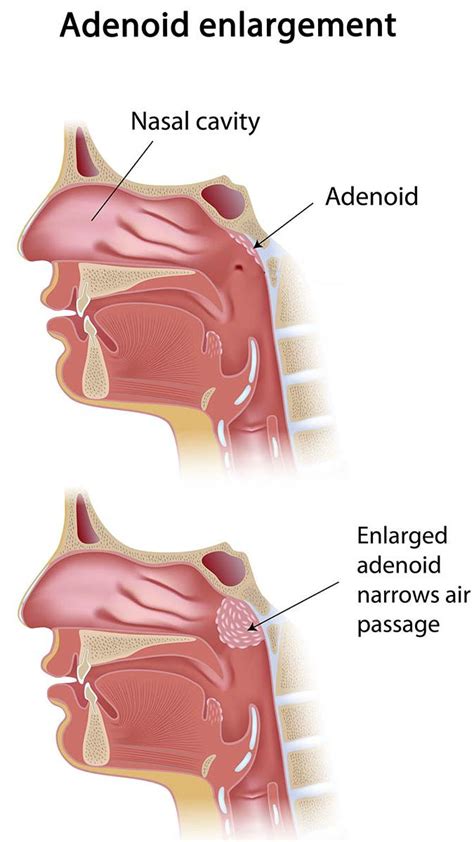 What Are Adenoids And Why Remove Them An Adenoidectomy Or Adenoid My Xxx Hot Girl