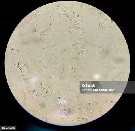 Sel Epitel Dalam Mikroskop Urin Gambar 40x Foto Stok Unduh Gambar Sekarang Mikroskop Fungal
