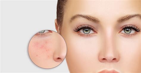 What You Should Know About Acne Dermatology Associates Savannah Ga