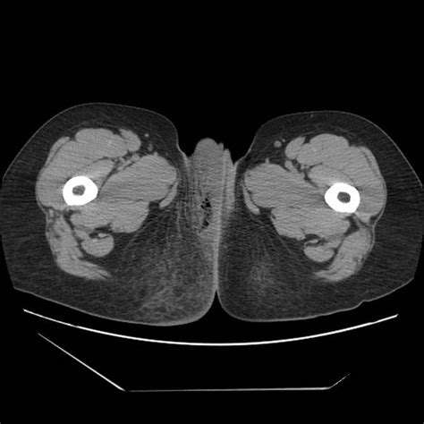 The physical exam findings are abstract fournier`s gangrene is a severe polymicrobial necrotizing fasciitis of the perineal, genital, or. Necrotizing perineal fasciitis | Radiology Case ...