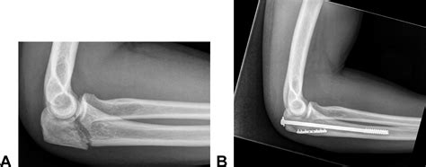 Surgical Techniques Of Olecranon Fractures Journal Of Hand Surgery