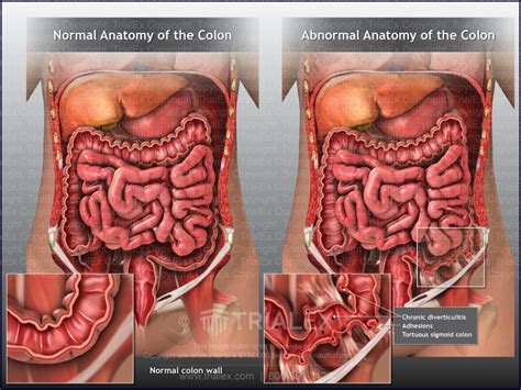 Abnormal Anatomy Of The Colon Diverticulitis Trialexhibits Inc