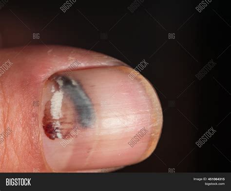 Close Finger Hematoma Image And Photo Free Trial Bigstock