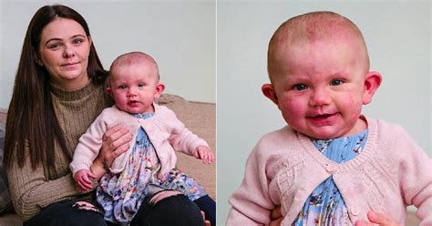 A Mom Hid Her Daughter Born With Purple Birthmarks For Six Weeks Amid