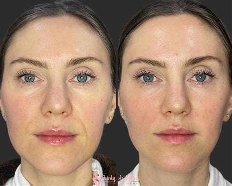 Smile Line Fillers Before After Results At Skinly