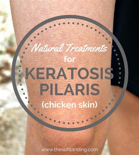 Natural Treatments For Keratosis Pilaris Chicken Skin Keratosis