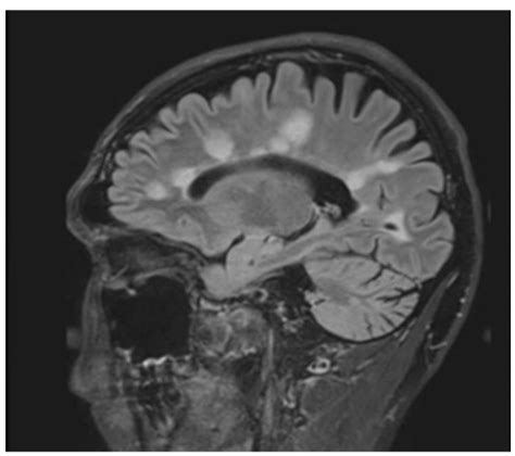 J Imaging Free Full Text Brain And Spinal Cord Mri Findings In