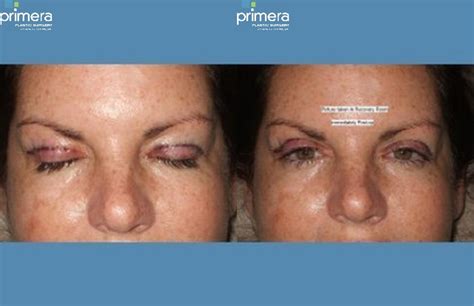 Blepharoplasty Before And After Pictures Case 262 Orlando Florida