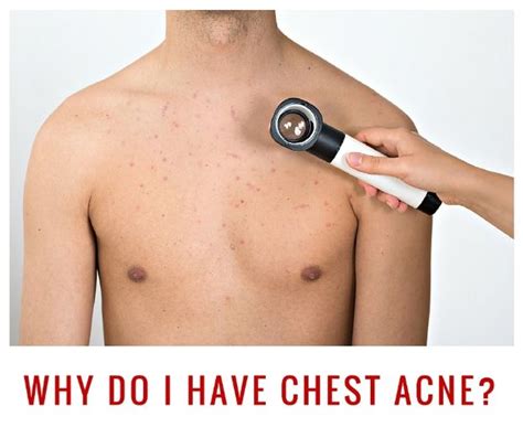 Chest Acne From Working Out Causes And Remedies Martlabpro
