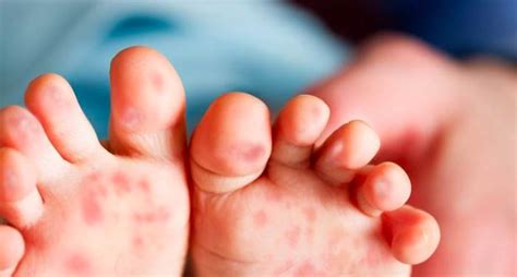 Is Hand Foot And Mouth Disease Hfmd Contagious Health Blog