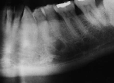 Lateral Periodontal Cysts Arising In Periapical Sites A Report Of Two