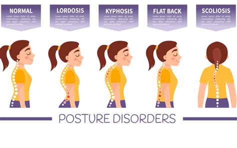 Types Of Body Posture Types Of Postural Deformities Mfine