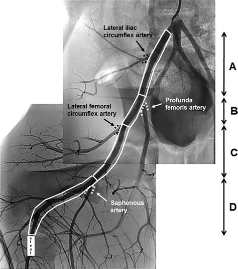 Novel Vessel Anatomy Adjusting Drug‐coated Balloon—preclinical