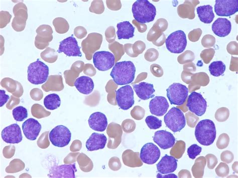 Leukemia In Children And Teens Together