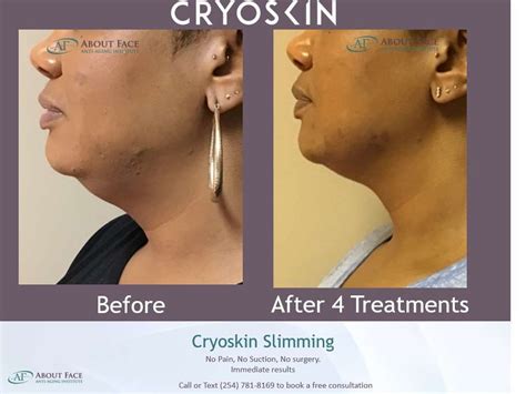 Cryoskin Slimming Treatment Before And After About Face