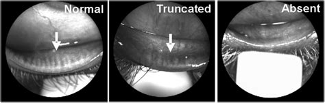 Infrared Meibography For Meibomian Gland Imaging Arrows Point To The