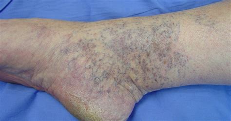 Skin Discoloration Inside Ankle Top Secret Skin Tips