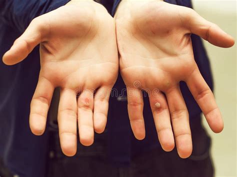 Hands With Blister And Callus Stock Image Image Of Skin Painful
