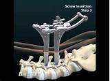 Side Effects Of Anterior Cervical Discectomy And Fusion Images