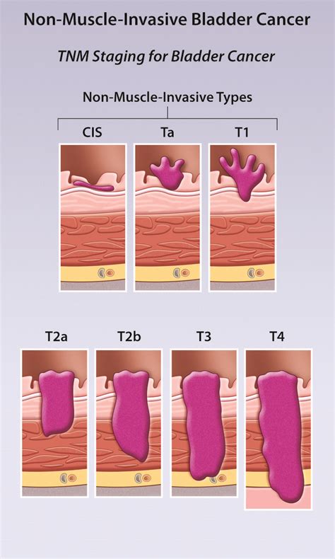 Non Muscle Invasive Bladder Cancer Review Of Diagnosis And Management Healthplexus Net