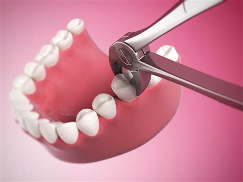 The Types Of Tooth Extractions Tulsa Precision Dental