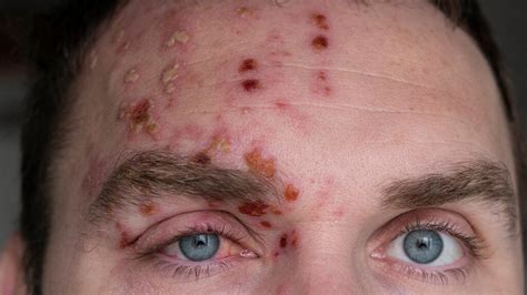 Shingles Symptoms Treatment And Causes