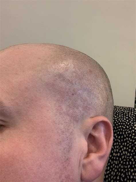 afânat colonie bun laser hair removal head Transparent cort Posteritate