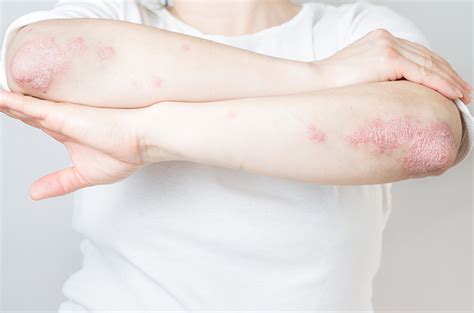 Kenali Gejala Psoriasis Yang Membedakannya Dengan Penyakit Kulit Lain