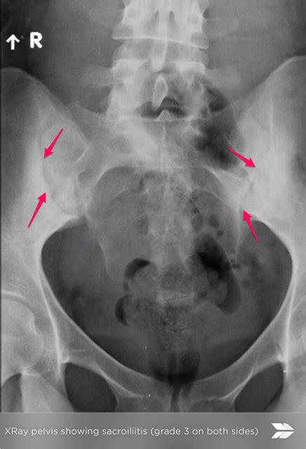 Sacroiliac Joint X Rays In Diagnosis Of Ankylosing Spondylitis