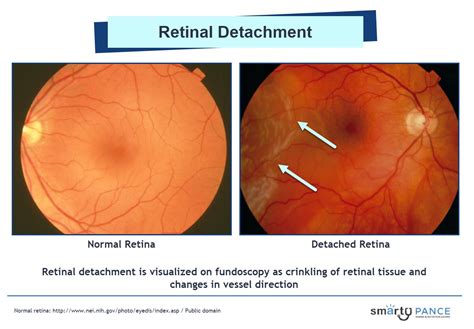 Retinal Detachment Retinal Detachment Detachment Blueprints