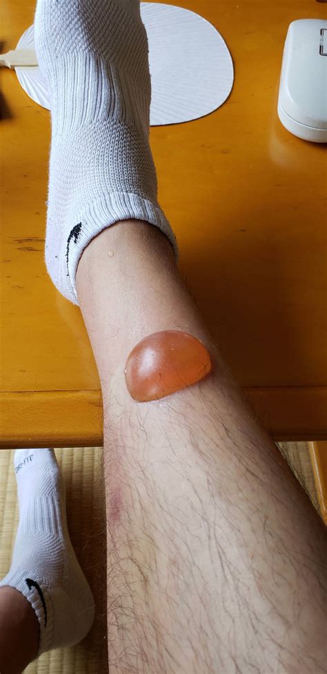Huge Blister From Mosquito Bite Askdocs