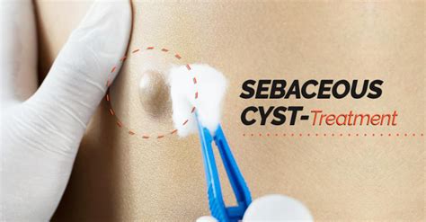 Sebaceous Cyst Treatments