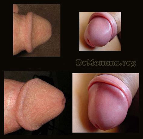 Uncircumcised Vs Circumcised Sex