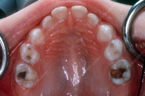Extensive Tooth Decay In Molars Stock Image C0393016 Science