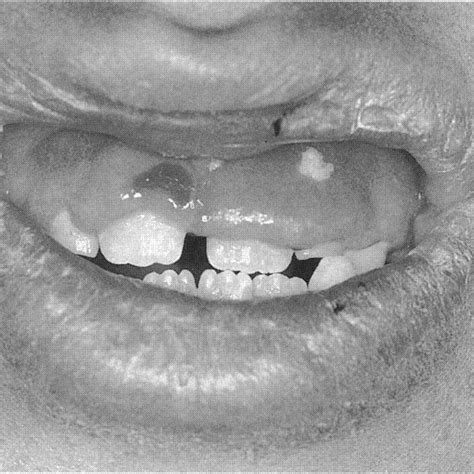Lip Swelling With Gingival Hypertrophy And Ulceration Download
